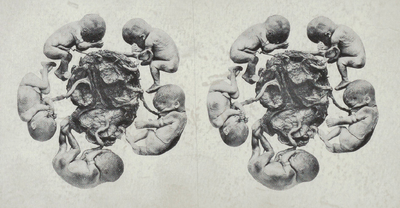 4730 lesmateriaal; zwangerschap; placenta; meerlingen; foetus, circa 1935