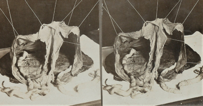 4835 lesmateriaal; twee-eiige; tweeling; placenta, circa 1930